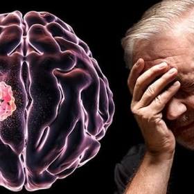 U Não: Dấu Hiệu Nhận Biết Sớm Và Phương Pháp Điều Trị