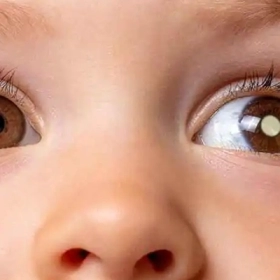 U Nguyên Bào Võng Mạc: Dấu Hiệu Nhận Biết Sớm Ở Trẻ Em