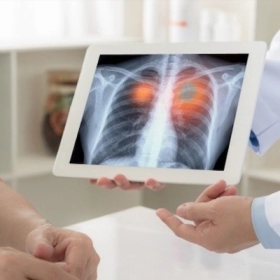 U Phổi Lành Tính: Các Loại Thường Gặp Và Khi Nào Cần Điều Trị