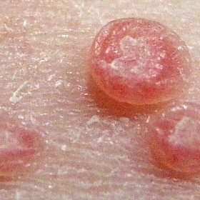 U Sùi Thể Nấm Là Gì? Nguyên Nhân, Triệu Chứng Và Cách Điều Trị