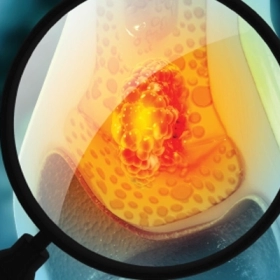 U Tế Bào Khổng Lồ: Dấu Hiệu, Nguy Cơ Và Cách Điều Trị