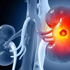 U Thận Là Gì? Nguyên Nhân, Dấu Hiệu Nhận Biết Và Cách Điều Trị Hiệu Quả