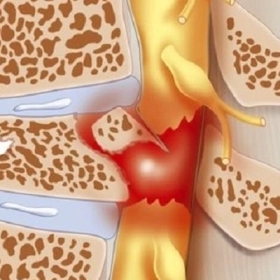 U Trong Ống Sống: Dấu Hiệu, Nguy Hiểm Và Phương Pháp Điều Trị