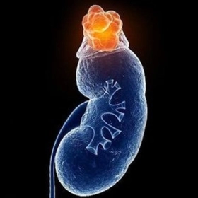 U Tủy Thượng Thận Là Gì? Nguyên Nhân, Triệu Chứng Và Phương Pháp Điều Trị