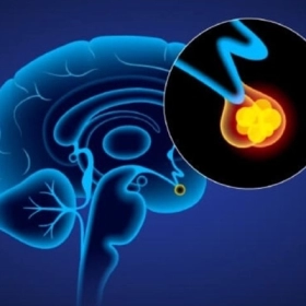 U Tuyến Yên Là Gì? Nguyên Nhân, Triệu Chứng Và Cách Điều Trị