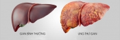 Ung thư gan