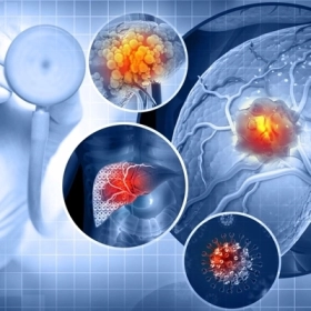 Ung Thư Gan Sống Được Bao Lâu? Tiên Lượng Theo Từng Giai Đoạn