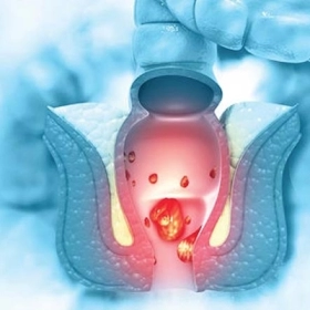 Ung Thư Hậu Môn Là Gì? Nguyên Nhân, Triệu Chứng Và Cách Điều Trị