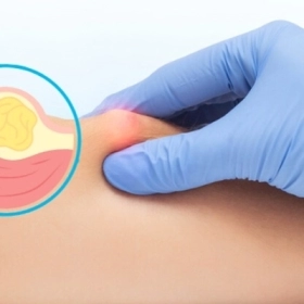 Ung Thư Mô Mỡ Là Gì? Nguyên Nhân, Triệu Chứng Và Cách Điều Trị