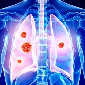 Ung Thư Phổi Không Tế Bào Nhỏ (NSCLC): Nguyên Nhân Và Điều Trị