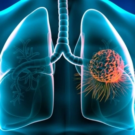 Ung Thư Phổi Là Gì? Nguyên Nhân, Triệu Chứng Và Hướng Điều Trị