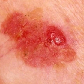 Ung Thư Tế Bào Vảy Là Gì? Nguyên Nhân, Triệu Chứng Và Cách Điều Trị