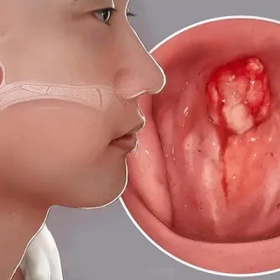 Ung Thư Xoang Là Gì? Nguyên Nhân, Dấu Hiệu Và Cách Điều Trị