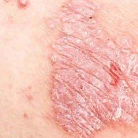 Vảy Nến Là Gì? Nguyên Nhân, Triệu Chứng Và Cách Điều Trị