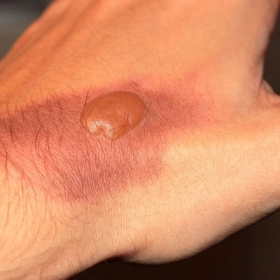 Vết Bỏng Bị Phồng Nước Phải Làm Sao? Cách Xử Lý Đúng Để Tránh Nhiễm Trùng