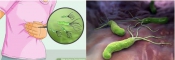 Vi khuẩn Helicobacter Pylori Vi khuẩn Helicobacter Pylori