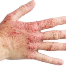 Viêm Da Cơ Địa Là Gì? Nguyên Nhân, Triệu Chứng Và Cách Điều Trị Hiệu Quả