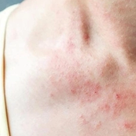 Viêm da dị ứng: Nguyên nhân, dấu hiệu và cách điều trị