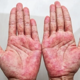 Viêm Da Tiếp Xúc: Nguyên Nhân, Triệu Chứng và Cách Điều Trị