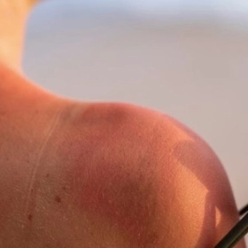 Viêm Da Tiếp Xúc Ánh Sáng: Nguyên Nhân, Triệu Chứng và Cách Điều Trị