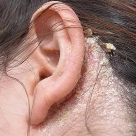 Viêm Da Tiết Bã Là Gì? Nguyên Nhân, Triệu Chứng Và Cách Điều Trị Hiệu Quả