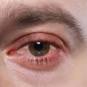 Viêm Kết Mạc Dị Ứng Là Gì? Nguyên Nhân, Triệu Chứng Và Cách Điều Trị