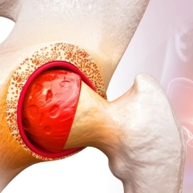 Viêm Khớp Háng: Nguyên Nhân, Triệu Chứng Và Cách Điều Trị