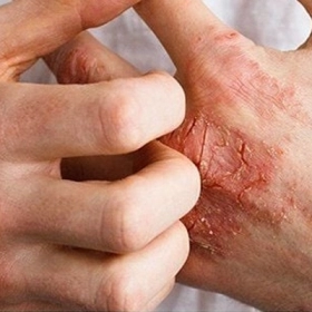 Viêm Khớp Vảy Nến: Nguyên Nhân, Triệu Chứng Và Cách Điều Trị Hiệu Quả