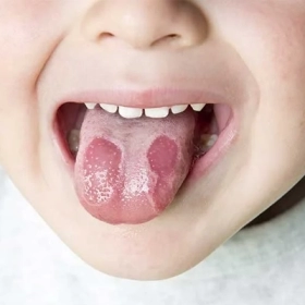 Viêm Lưỡi Bản Đồ Là Gì? Nguyên Nhân, Triệu Chứng Và Cách Nhận Biết