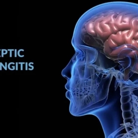 Viêm màng não vô khuẩn: Nguyên nhân, triệu chứng và cách điều trị