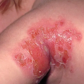 Viêm Mô Tế Bào Là Gì? Nguyên Nhân, Triệu Chứng Và Cách Điều Trị