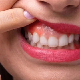 Viêm Nướu Răng Là Gì? Nguyên Nhân, Dấu Hiệu Và Cách Điều Trị Hiệu Quả
