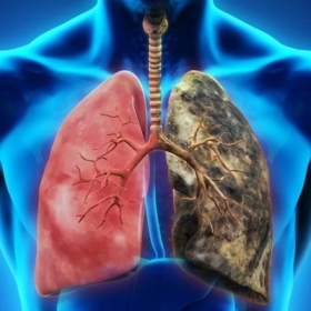 Viêm Phổi Kẽ Tróc Vảy Là Gì? Nguyên Nhân Và Dấu Hiệu Nhận Biết