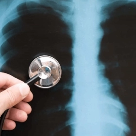 Viêm Phổi Thùy Là Gì? Nguyên Nhân, Triệu Chứng Và Cách Điều Trị