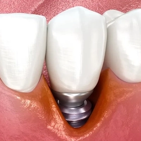 Viêm Quanh Implant Là Gì? Nguyên Nhân, Dấu Hiệu Và Cách Điều Trị