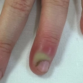 Viêm quanh móng: Nguyên nhân, triệu chứng và giải pháp điều trị