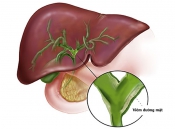 Viêm túi mật cấp