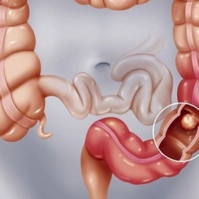 Viêm Túi Thừa Là Gì? Nguyên Nhân, Triệu Chứng Và Cách Điều Trị