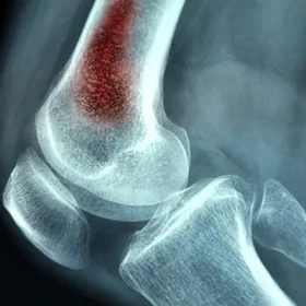 Viêm Tủy Xương: Nguyên Nhân, Triệu Chứng Và Cách Điều Trị