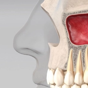 Viêm Xoang Hàm Là Gì? Nguyên Nhân, Triệu Chứng Và Cách Điều Trị