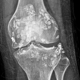 Vôi Hóa Sụn Khớp: Nguyên Nhân, Triệu Chứng Và Cách Điều Trị