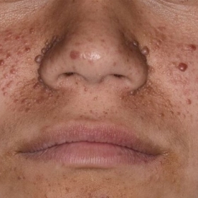 Xơ cứng củ: Nguyên nhân, triệu chứng và cách điều trị