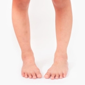 Xoắn Xương Chày: Nguyên Nhân, Dấu Hiệu Và Cách Điều Trị Hiệu Quả