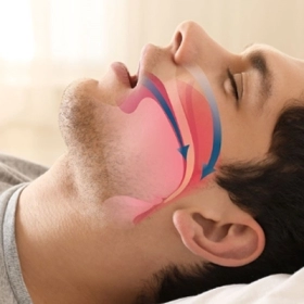 Zepbound Và Mounjaro Có Giúp Cải Thiện Chứng Ngưng Thở Khi Ngủ?