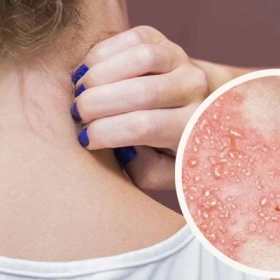 Zona thần kinh: Dấu hiệu, nguyên nhân và cách điều trị